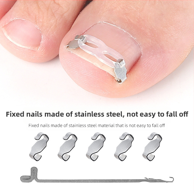 Ортопедично устройство за враснали нокти на краката с тракционен пластир за коригиране на враснали нокти