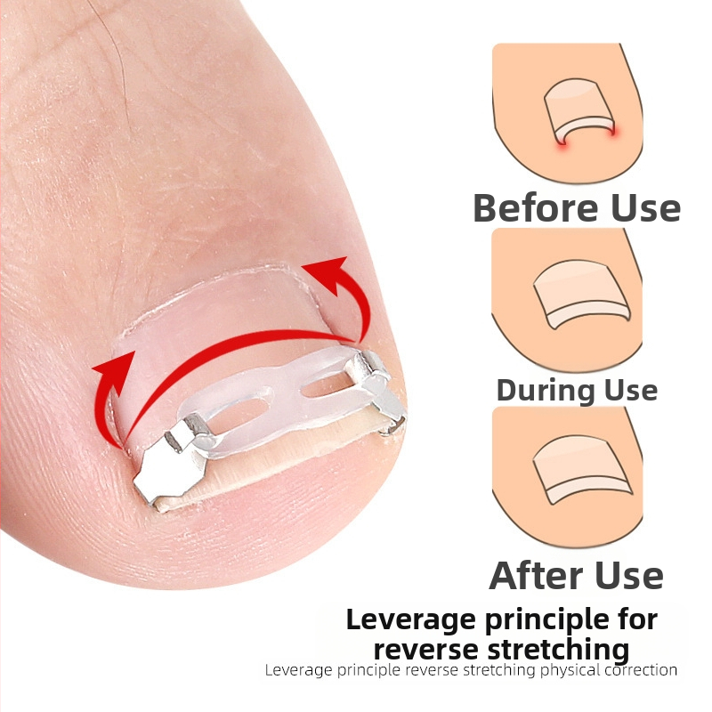 Ортопедично устройство за враснали нокти на краката с тракционен пластир за коригиране на враснали нокти