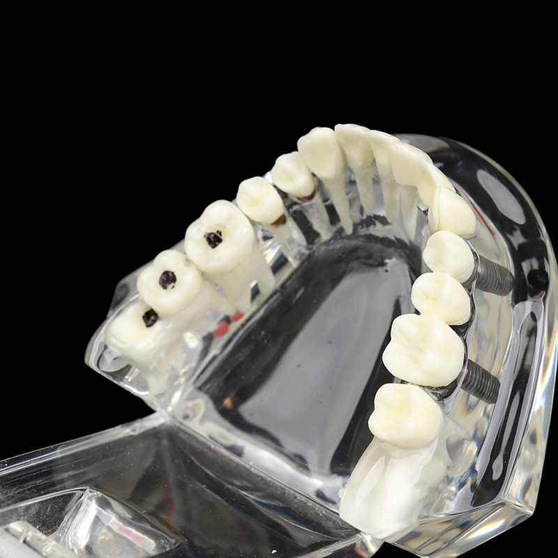 Зъбен модел със патологични характеристики, мостов модел и имплантен модел — сваляем, за възрастни