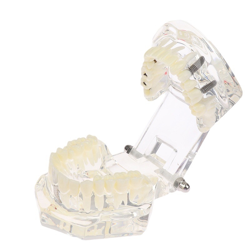 Зъбен модел със патологични характеристики, мостов модел и имплантен модел — сваляем, за възрастни