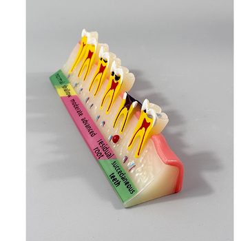 Month Ρητίνη Οδοντιατρικό Εκπαιδευτικό Μοντέλο – Επικοινωνία Ασθενούς-Γιατρού, Περιοδοντικό Μοντέλο Κατηγορίας B