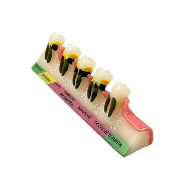 Month Ρητίνη Οδοντιατρικό Εκπαιδευτικό Μοντέλο – Επικοινωνία Ασθενούς-Γιατρού, Περιοδοντικό Μοντέλο Κατηγορίας B