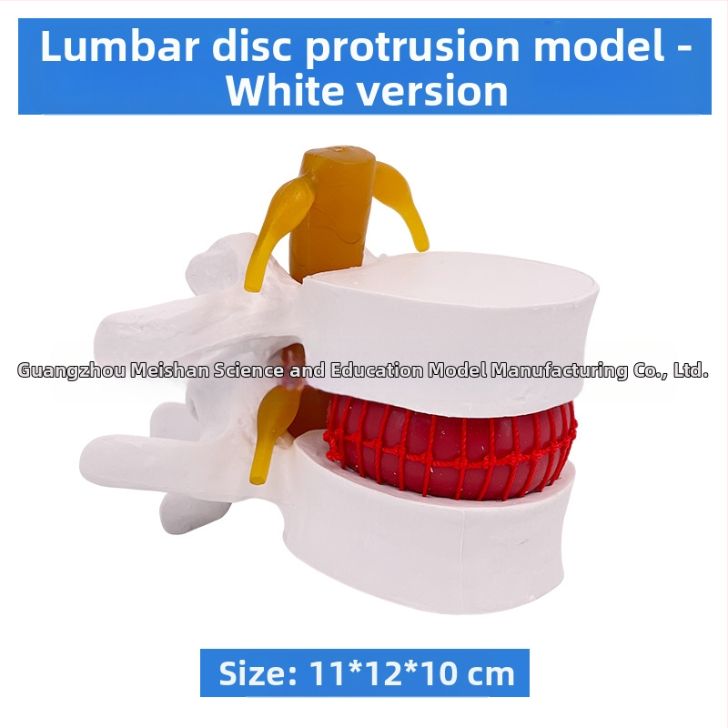 Лумбален модел за медицинско обучение – демонстрация на компресия на лумбалния диск и патология на костите на гръбначния стълб.