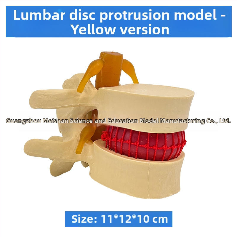 Лумбален модел за медицинско обучение – демонстрация на компресия на лумбалния диск и патология на костите на гръбначния стълб.