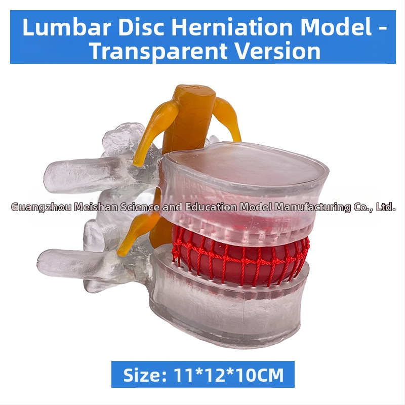 Лумбален модел за медицинско обучение – демонстрация на компресия на лумбалния диск и патология на костите на гръбначния стълб.
