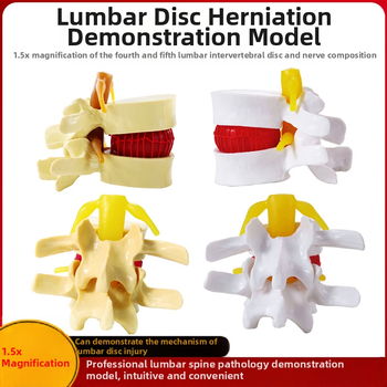 Модел на междупрешленния диск, PVC учебен анатомичен модел за демонстрация на патология на лумбалния гръбнак, Zhenghe River