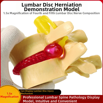 Модел на междупрешленния диск, PVC учебен анатомичен модел за демонстрация на патология на лумбалния гръбнак, Zhenghe River