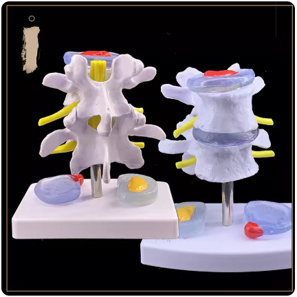 Модел на междупрешленния диск, PVC учебен анатомичен модел за демонстрация на патология на лумбалния гръбнак, Zhenghe River