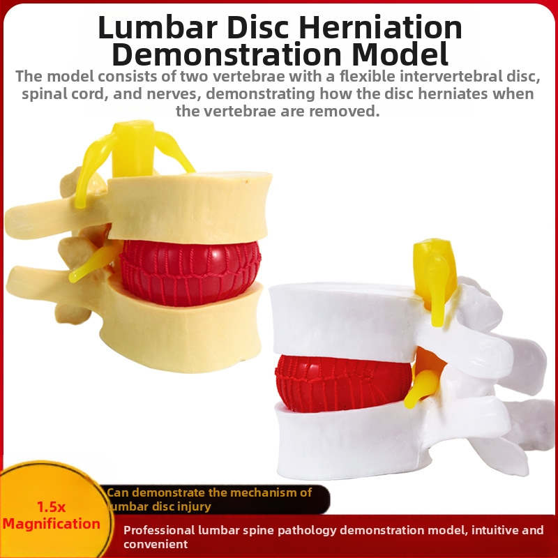 Модел на междупрешленния диск, PVC учебен анатомичен модел за демонстрация на патология на лумбалния гръбнак, Zhenghe River