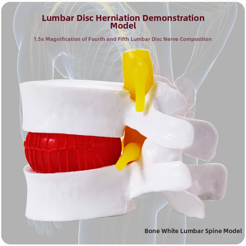Модел на междупрешленния диск, PVC учебен анатомичен модел за демонстрация на патология на лумбалния гръбнак, Zhenghe River