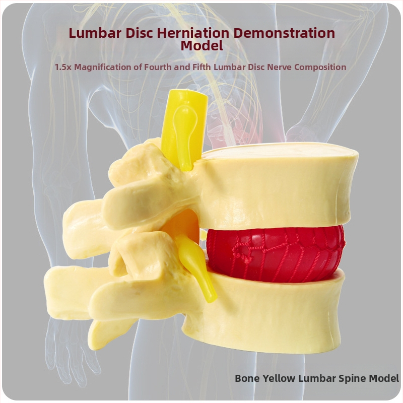 Модел на междупрешленния диск, PVC учебен анатомичен модел за демонстрация на патология на лумбалния гръбнак, Zhenghe River