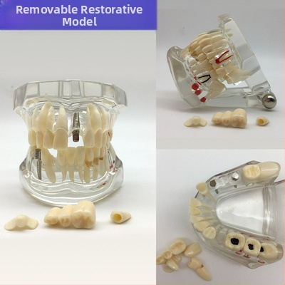 Μοντέλο διδασκαλίας οδοντιατρικής με παθολογική αποκατάσταση και τυπικό καλούπι εμφυτευμάτων — εγχώριο εμπορικό σήμα, με εκτυπωμένο λογότυπο, κατάλληλο για την οδοντιατρική εκπαίδευση