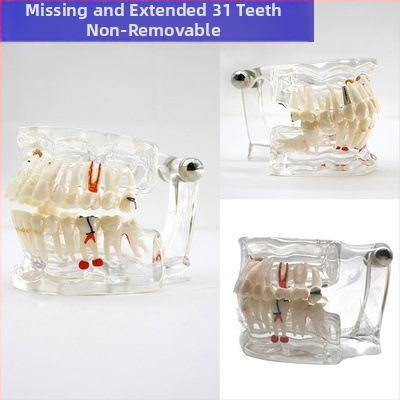 Μοντέλο διδασκαλίας οδοντιατρικής με παθολογική αποκατάσταση και τυπικό καλούπι εμφυτευμάτων — εγχώριο εμπορικό σήμα, με εκτυπωμένο λογότυπο, κατάλληλο για την οδοντιατρική εκπαίδευση