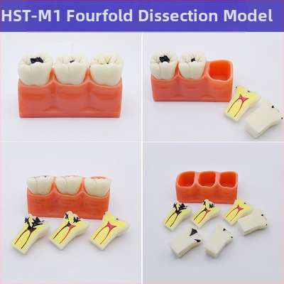 Μοντέλο διδασκαλίας οδοντιατρικής με παθολογική αποκατάσταση και τυπικό καλούπι εμφυτευμάτων — εγχώριο εμπορικό σήμα, με εκτυπωμένο λογότυπο, κατάλληλο για την οδοντιατρική εκπαίδευση