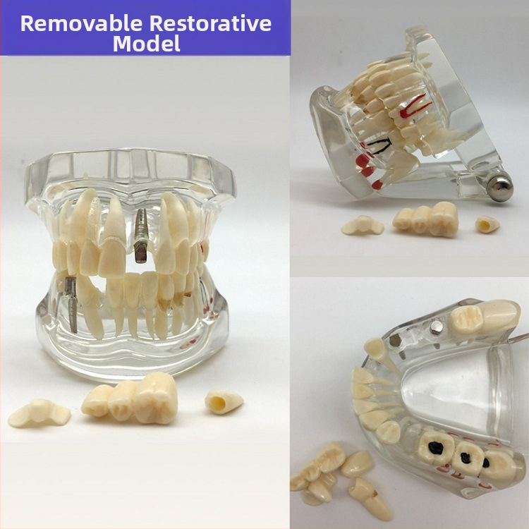 Учебен стоматологичен модел за дентална патология и възстановяване със стандартен имплантен модел, местен бранд, с печатано лого, подходящ за стоматологично обучение