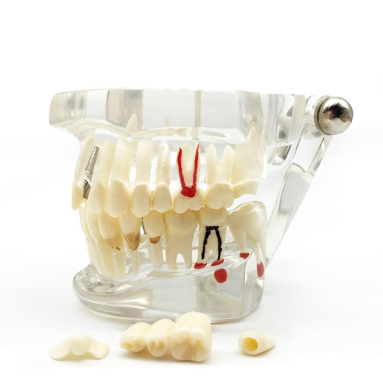 Μοντέλο διδασκαλίας οδοντιατρικής με παθολογική αποκατάσταση και τυπικό καλούπι εμφυτευμάτων — εγχώριο εμπορικό σήμα, με εκτυπωμένο λογότυπο, κατάλληλο για την οδοντιατρική εκπαίδευση