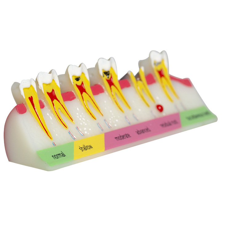 Fogászati oktató fogmodell, levehető fogpótlás, ABS gyanta, felnőtteknek, 180 g