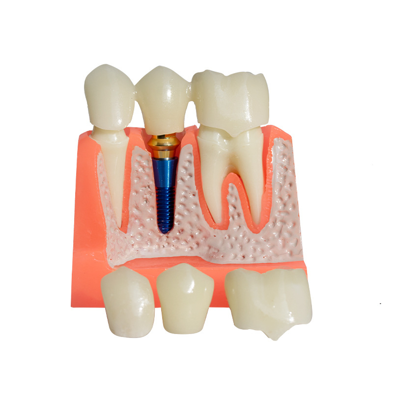 Fogászati oktató fogmodell, levehető fogpótlás, ABS gyanta, felnőtteknek, 180 g
