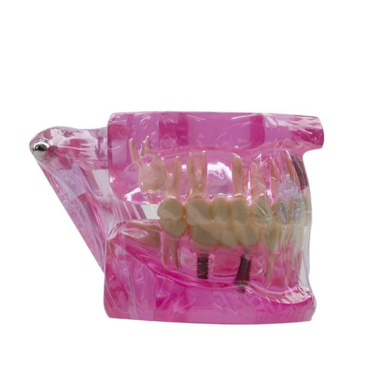 Fogászati oktató fogmodell, levehető fogpótlás, ABS gyanta, felnőtteknek, 180 g