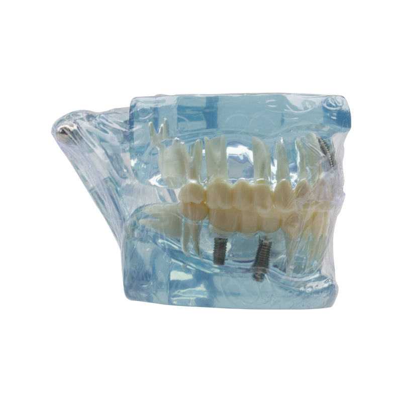 Fogászati oktató fogmodell, levehető fogpótlás, ABS gyanta, felnőtteknek, 180 g