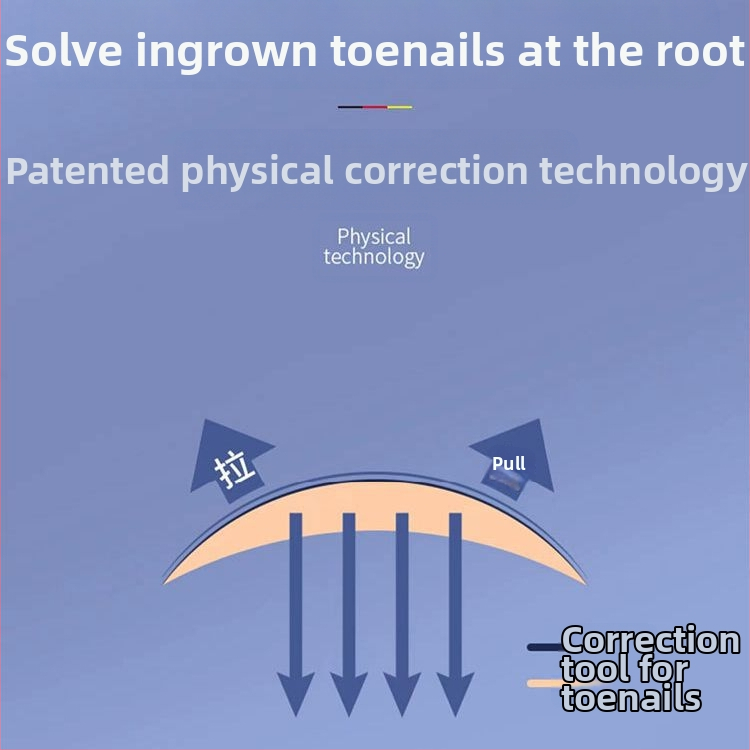 Nagų įdaužos žnyplių rinkinys – nerūdijančio plieno, koregavimas įaugusiam nagui