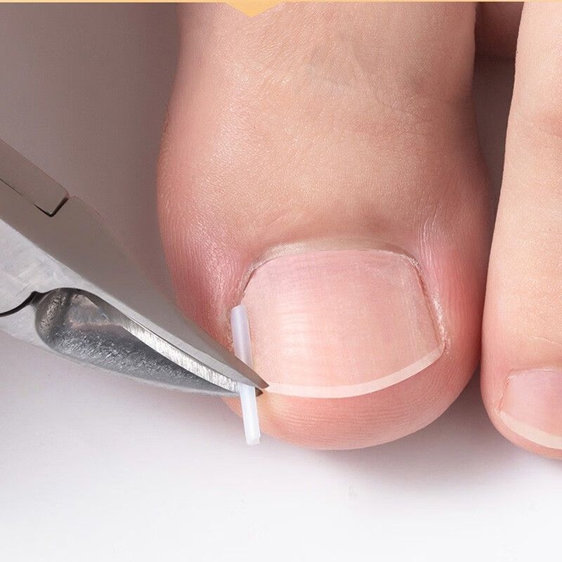 Μίνι πλαστικό υπόθεμα διόρθωσης για το νύχι του μεγάλου δακτύλου, φορητό και σκίζεται