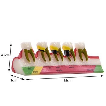 Model dentar parodontal – demonstrație a evoluției cariilor și a clasificării afecțiunilor parodontale; material: rășină; ambalare: 100 buc.; Barcode: 456789
