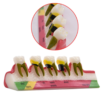 Model dentar parodontal – demonstrație a evoluției cariilor și a clasificării afecțiunilor parodontale; material: rășină; ambalare: 100 buc.; Barcode: 456789