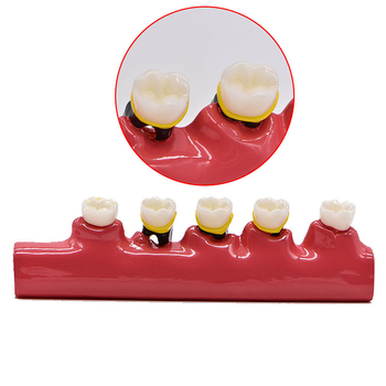 Model dentar parodontal – demonstrație a evoluției cariilor și a clasificării afecțiunilor parodontale; material: rășină; ambalare: 100 buc.; Barcode: 456789