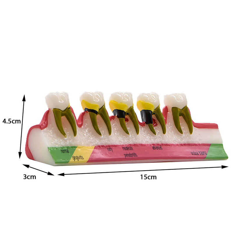 Model dentar parodontal – demonstrație a evoluției cariilor și a clasificării afecțiunilor parodontale; material: rășină; ambalare: 100 buc.; Barcode: 456789