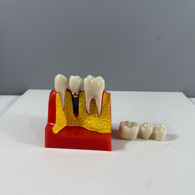 Dantų mokymo modelis studentų praktikai su implantavimo smeigių demonstravimu, dervos medžiaga, prekinis ženklas Liyue; palaiko privačias prekes