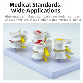 Blue Butterfly PVC четирисекционен модел на лумбалния гръбнак: нормални и патологични прешлени с дискова патология