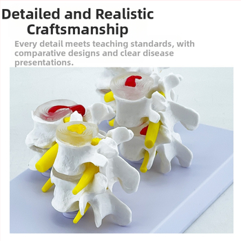 Blue Butterfly PVC четирисекционен модел на лумбалния гръбнак: нормални и патологични прешлени с дискова патология