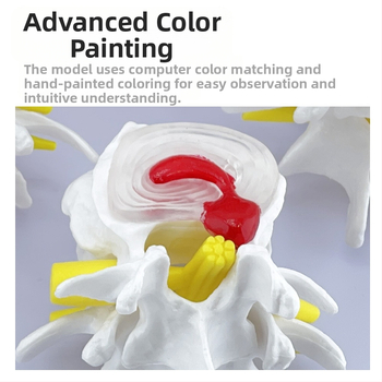 Blue Butterfly PVC четирисекционен модел на лумбалния гръбнак: нормални и патологични прешлени с дискова патология