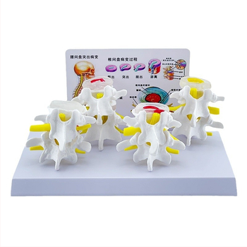 Blue Butterfly PVC четирисекционен модел на лумбалния гръбнак: нормални и патологични прешлени с дискова патология