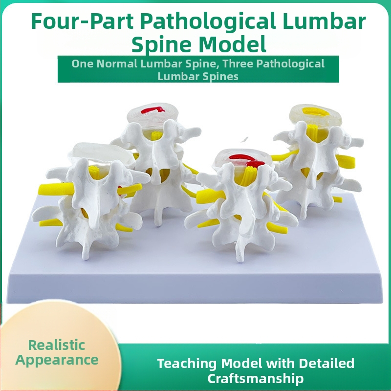 Blue Butterfly PVC четирисекционен модел на лумбалния гръбнак: нормални и патологични прешлени с дискова патология