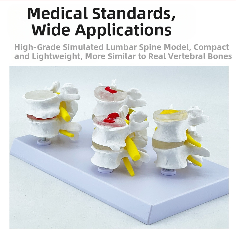 Blue Butterfly PVC четирисекционен модел на лумбалния гръбнак: нормални и патологични прешлени с дискова патология