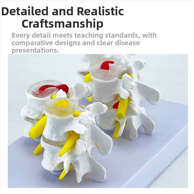 Blue Butterfly PVC четирисекционен модел на лумбалния гръбнак: нормални и патологични прешлени с дискова патология