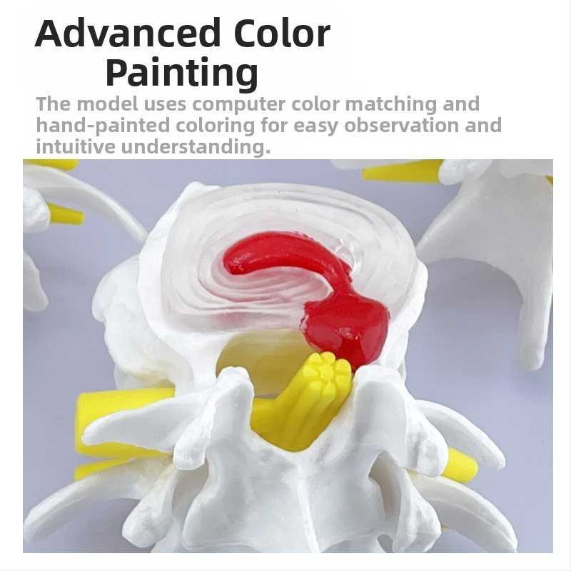 Blue Butterfly PVC четирисекционен модел на лумбалния гръбнак: нормални и патологични прешлени с дискова патология