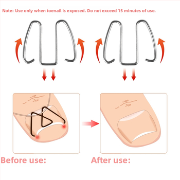 Ορθωτικό νυχιού για ingrown nail; υλικό: πλαστικό + ανοξείδωτο ατσάλι; περιεκτικότητα: 12.3; συσκευασία: 1000 τεμάχια; μάρκα: Feet wake up