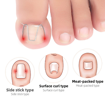 Ορθωτικό νυχιού για ingrown nail; υλικό: πλαστικό + ανοξείδωτο ατσάλι; περιεκτικότητα: 12.3; συσκευασία: 1000 τεμάχια; μάρκα: Feet wake up