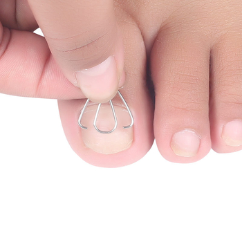 Ορθωτικό νυχιού για ingrown nail; υλικό: πλαστικό + ανοξείδωτο ατσάλι; περιεκτικότητα: 12.3; συσκευασία: 1000 τεμάχια; μάρκα: Feet wake up