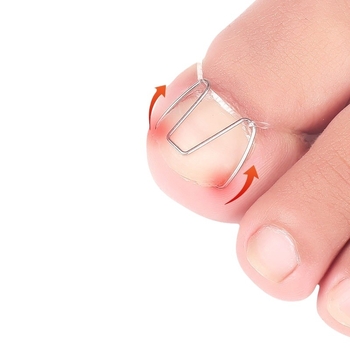 Ορθωτικό νυχιού για ingrown nail; υλικό: πλαστικό + ανοξείδωτο ατσάλι; περιεκτικότητα: 12.3; συσκευασία: 1000 τεμάχια; μάρκα: Feet wake up