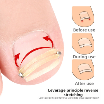 Δαχτύλι ποδιού για νύχια με μηχανισμό εφελκυστικής ανάκαμψης και κύλινδρο αυλακώσεων νυχιών; πλενόμενος και επαναχρησιμοποιήσιμος, 18 g