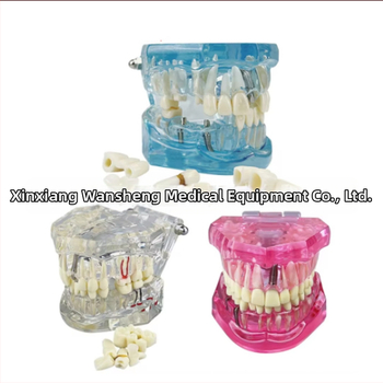 Οδοντιατρικό μοντέλο με παθολογικό στοιχείο, μοντέλο γέφυρας και εμφυτεύματος, αποσπώμενο, κατάλληλο για ενήλικες