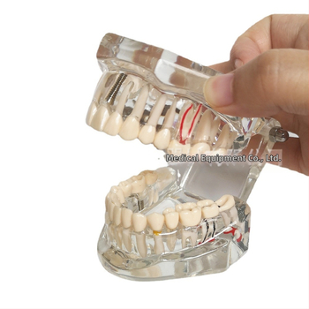 Οδοντιατρικό μοντέλο με παθολογικό στοιχείο, μοντέλο γέφυρας και εμφυτεύματος, αποσπώμενο, κατάλληλο για ενήλικες