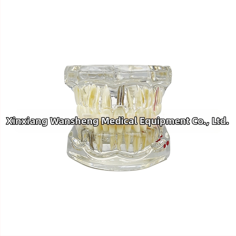 Οδοντιατρικό μοντέλο με παθολογικό στοιχείο, μοντέλο γέφυρας και εμφυτεύματος, αποσπώμενο, κατάλληλο για ενήλικες