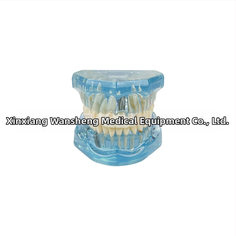 Οδοντιατρικό μοντέλο με παθολογικό στοιχείο, μοντέλο γέφυρας και εμφυτεύματος, αποσπώμενο, κατάλληλο για ενήλικες