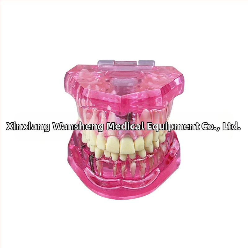 Οδοντιατρικό μοντέλο με παθολογικό στοιχείο, μοντέλο γέφυρας και εμφυτεύματος, αποσπώμενο, κατάλληλο για ενήλικες