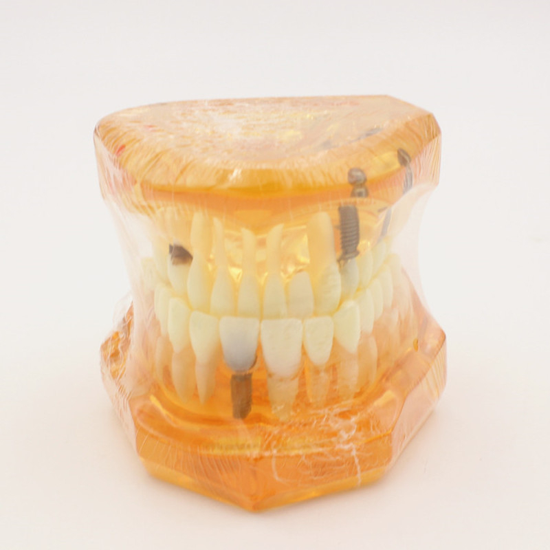 Οδοντιατρικό μοντέλο με παθολογικό στοιχείο, μοντέλο γέφυρας και εμφυτεύματος, αποσπώμενο, κατάλληλο για ενήλικες